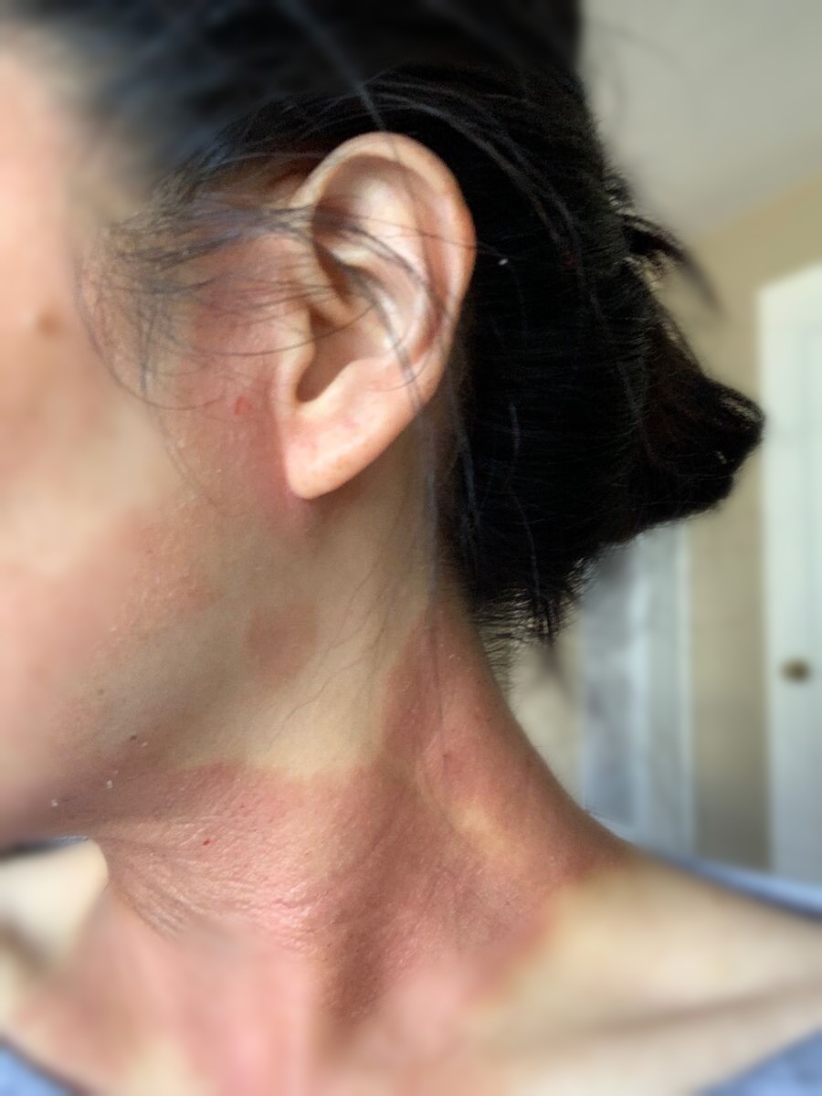 Eczema flare on neck