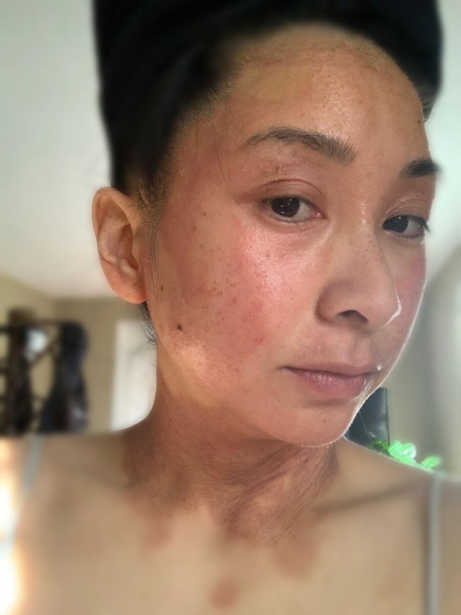 Eczema flare on face