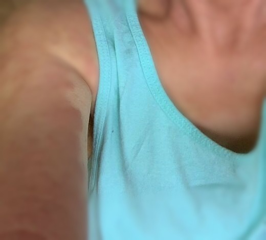 Eczema flare welts on arm