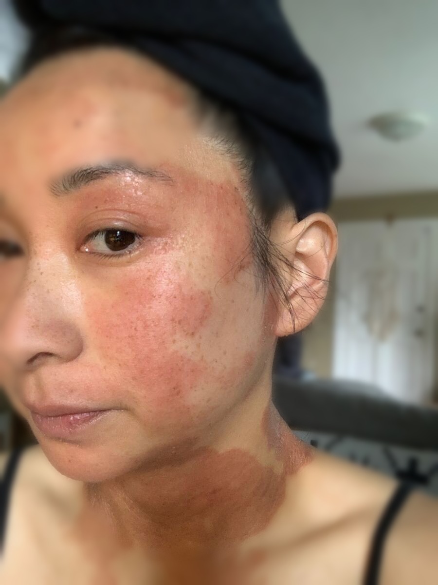 Eczema flare on face and neck